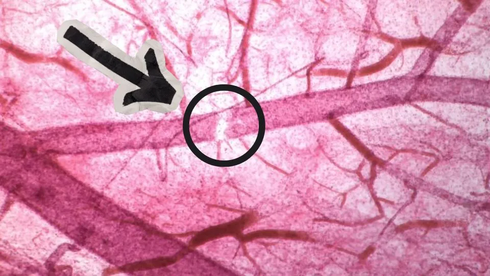 Microscope image of a leaky vein — tiny holes where fluid from the blood leaks out into the surrounding tissue
